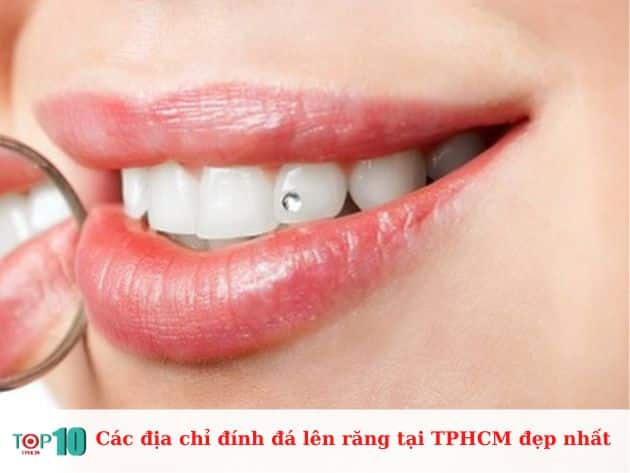 Các địa chỉ đính đá lên răng tại TPHCM đẹp nhất