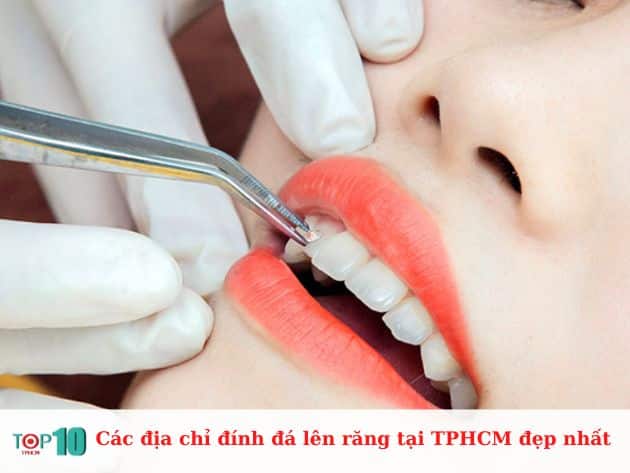 Các địa chỉ đính đá lên răng tại TPHCM đẹp nhất