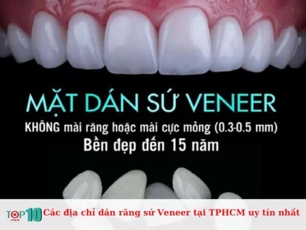 Các địa chỉ dán răng sứ Veneer tại TPHCM uy tín nhất