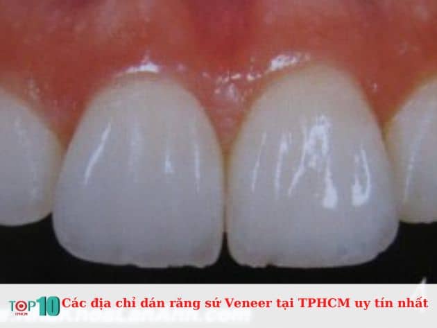 Các địa chỉ dán răng sứ Veneer tại TPHCM uy tín nhất