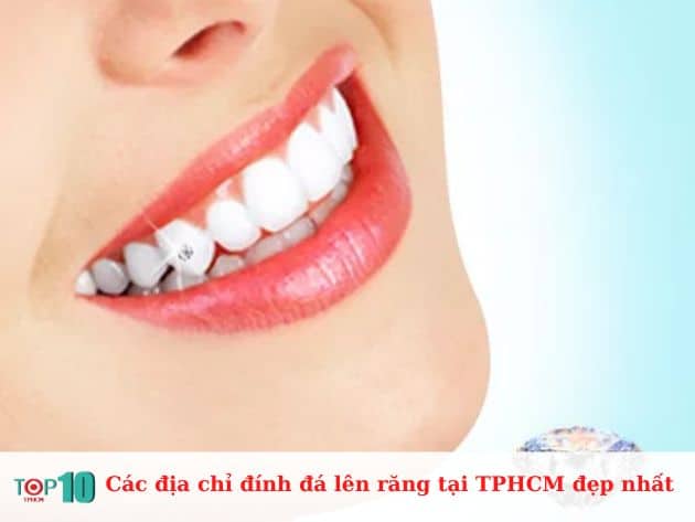 Các địa chỉ đính đá lên răng tại TPHCM đẹp nhất