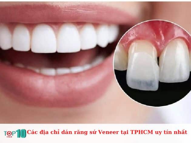 Các địa chỉ dán răng sứ Veneer tại TPHCM uy tín nhất