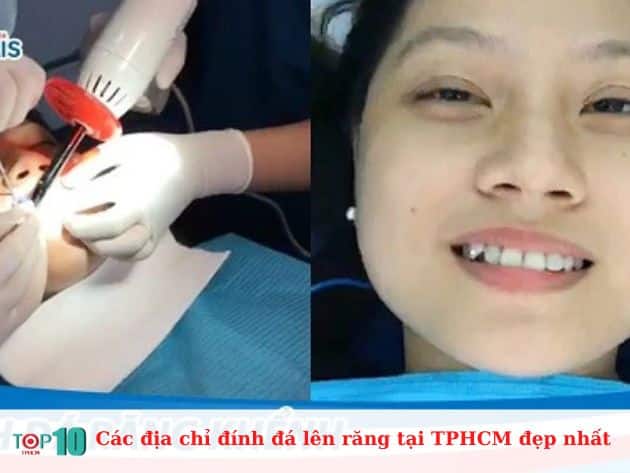 Các địa chỉ đính đá lên răng tại TPHCM đẹp nhất