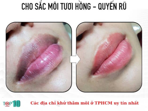 Các địa chỉ khử thâm môi ở TPHCM uy tín nhất