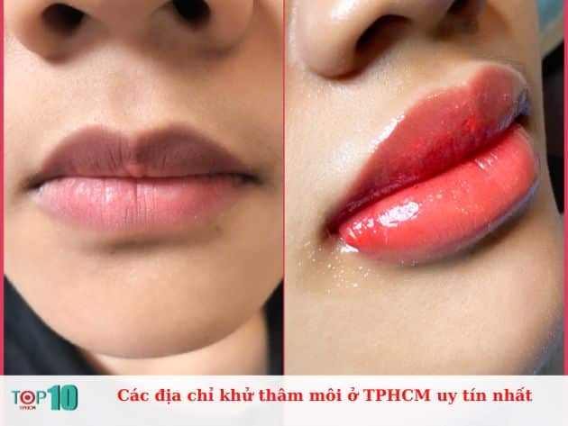 Các địa chỉ khử thâm môi ở TPHCM uy tín nhất