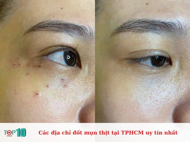 Các địa chỉ đốt mụn thịt tại TPHCM uy tín nhất