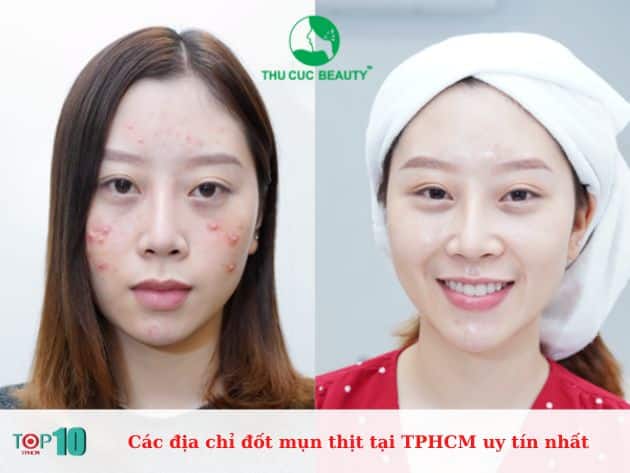 Các địa chỉ đốt mụn thịt tại TPHCM uy tín nhất