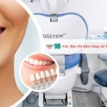Các địa chỉ dán răng sứ Veneer tại TPHCM uy tín nhất
