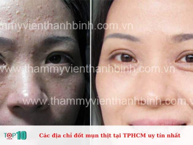 Các địa chỉ đốt mụn thịt tại TPHCM uy tín nhất