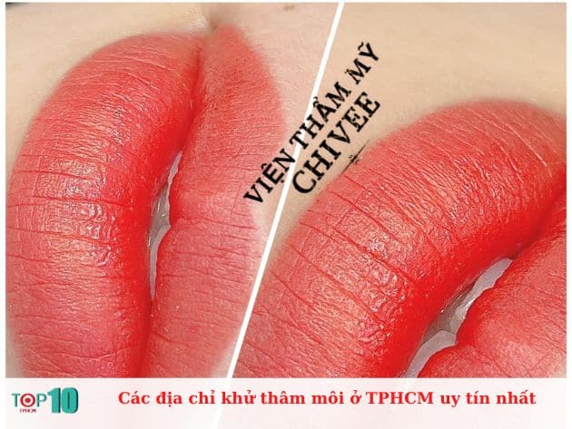 Các địa chỉ khử thâm môi ở TPHCM uy tín nhất