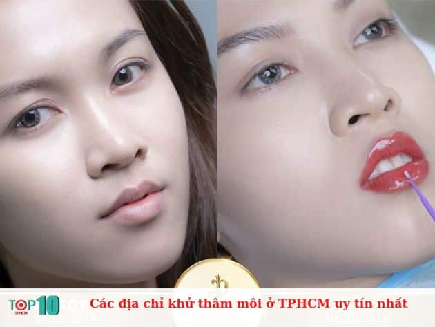 Các địa chỉ khử thâm môi ở TPHCM uy tín nhất