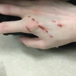 Hình ảnh té xe trầy xước tay chân của nam, nữ