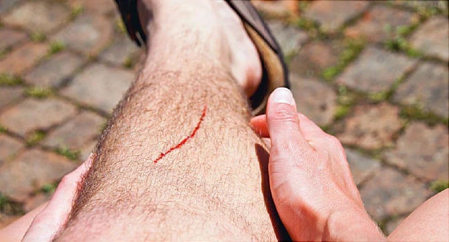 Anh xước chân bị thương sau khi bị té xe.