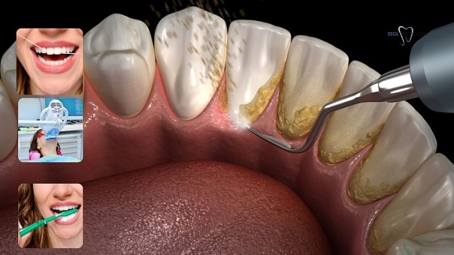 Vệ sinh Implant tại nha khoa là quy trình chuyên sâu, giúp làm sạch toàn bộ vùng mô quanh trụ Implant