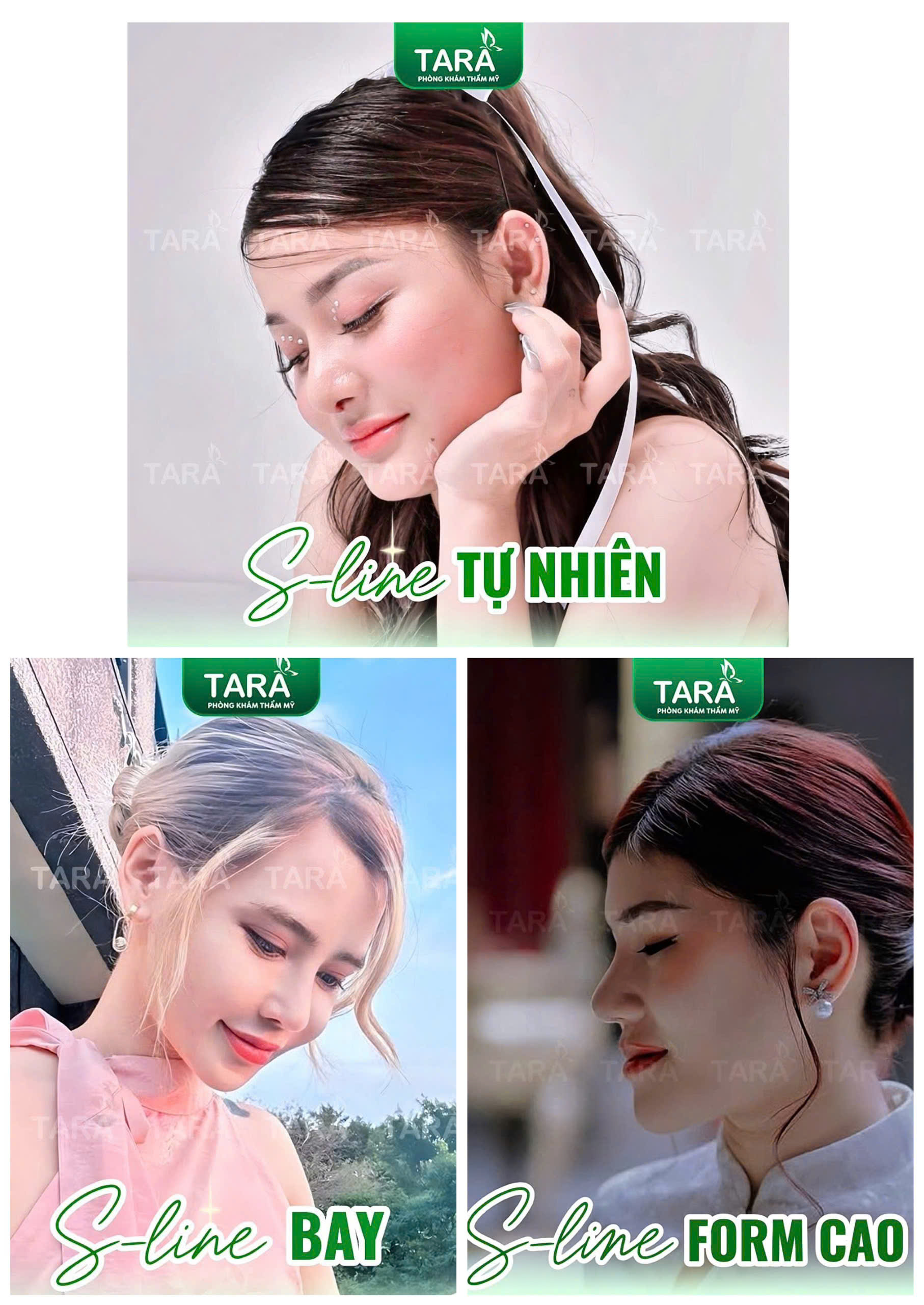 Hình ảnh chân thực của khách hàng sau khi nâng mũi tại Dr. Trang Tara