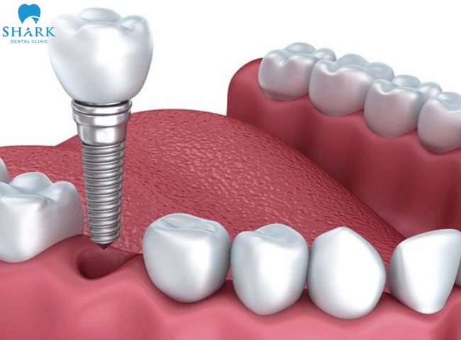 Răng Implant giúp thay thế răng đã mất, khôi phục chức năng ăn nhai và thẩm mỹ như răng thật.