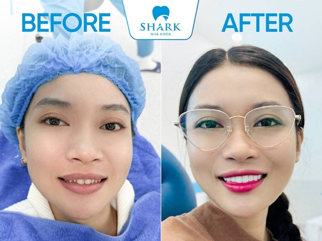 Sau khi trồng răng Implant tại Nha khoa Shark, khách hàng sẽ sở hữu hàm răng đều đẹp và tự nhiên như răng thật.