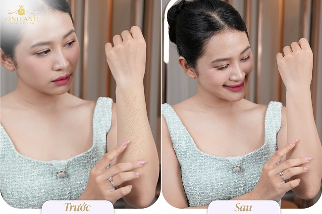 Hiệu quả triệt lông tại Linh Anh được nhiều khách hàng trải nghiệm và đánh giá