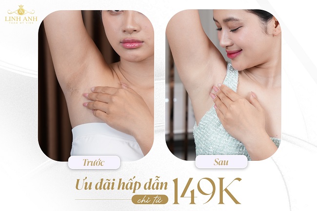 Triệt lông công nghệ cao tại Thẩm mỹ Quốc tế Linh Anh đang ưu đãi chỉ từ 149k